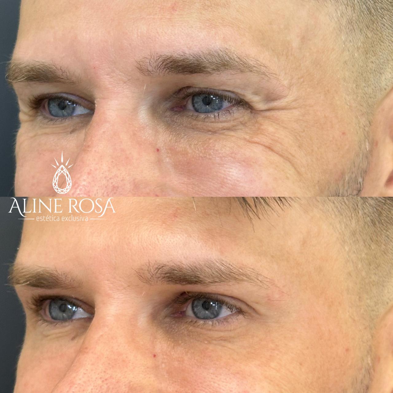 Botox Terço Superior Masculino